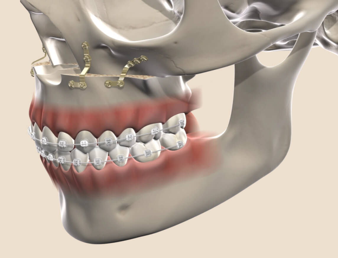 3D illustration of corrective jaw surgery with braces and fixation plates for orthognathic treatment.