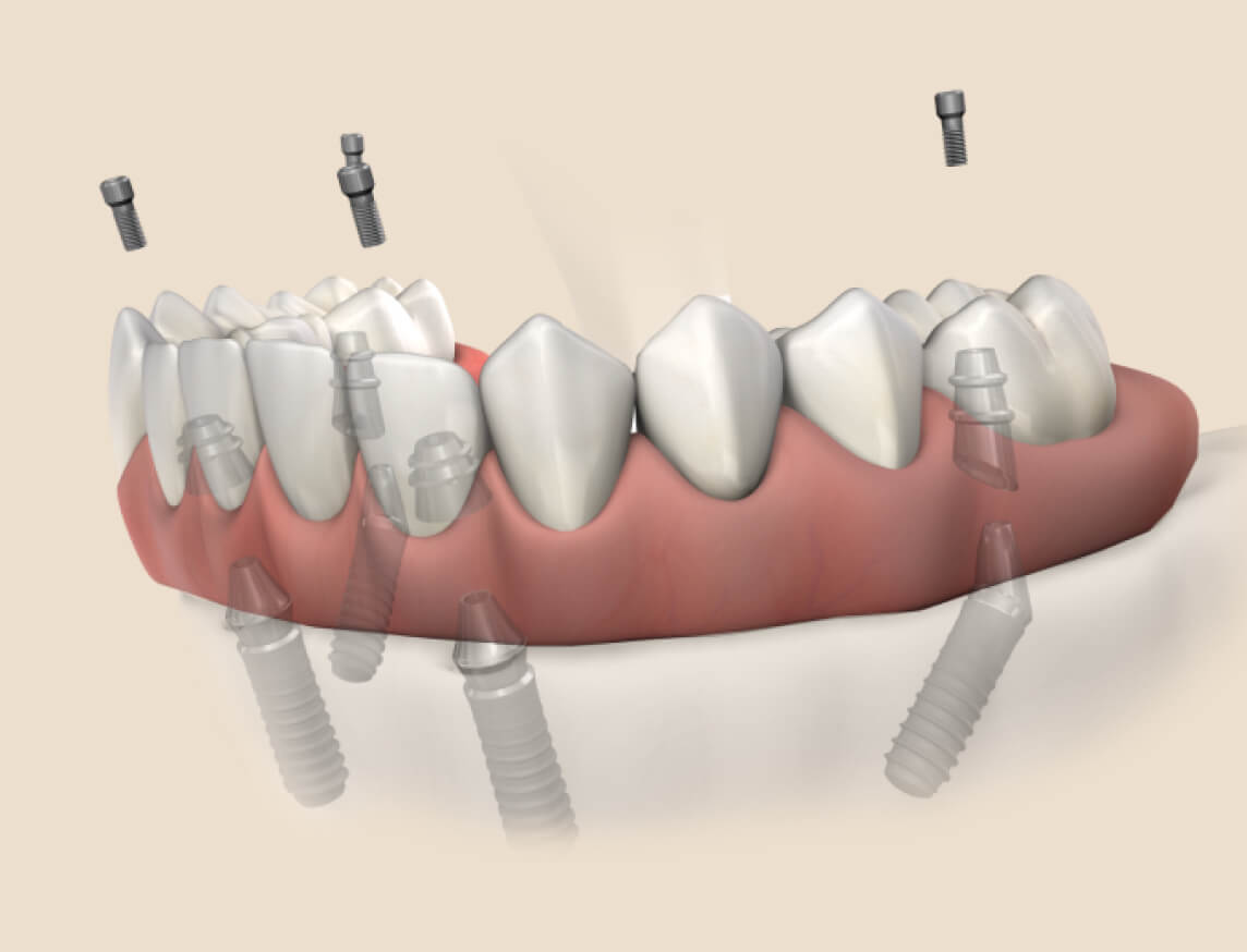 3D illustration of full-arch dental implants supporting replacement teeth for jaw restoration.