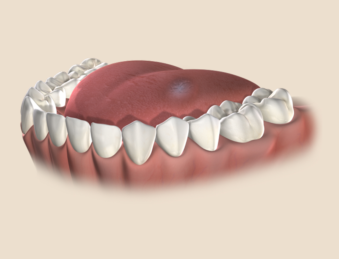 3D illustration of oral pathology concern on the tongue for oral surgery evaluation.