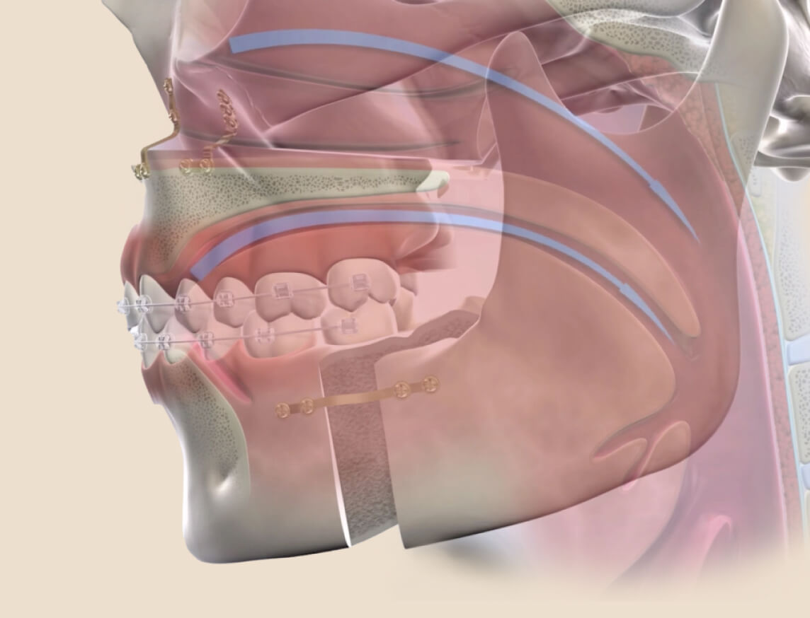 3D illustration of corrective jaw surgery showing airway improvement and jaw repositioning.