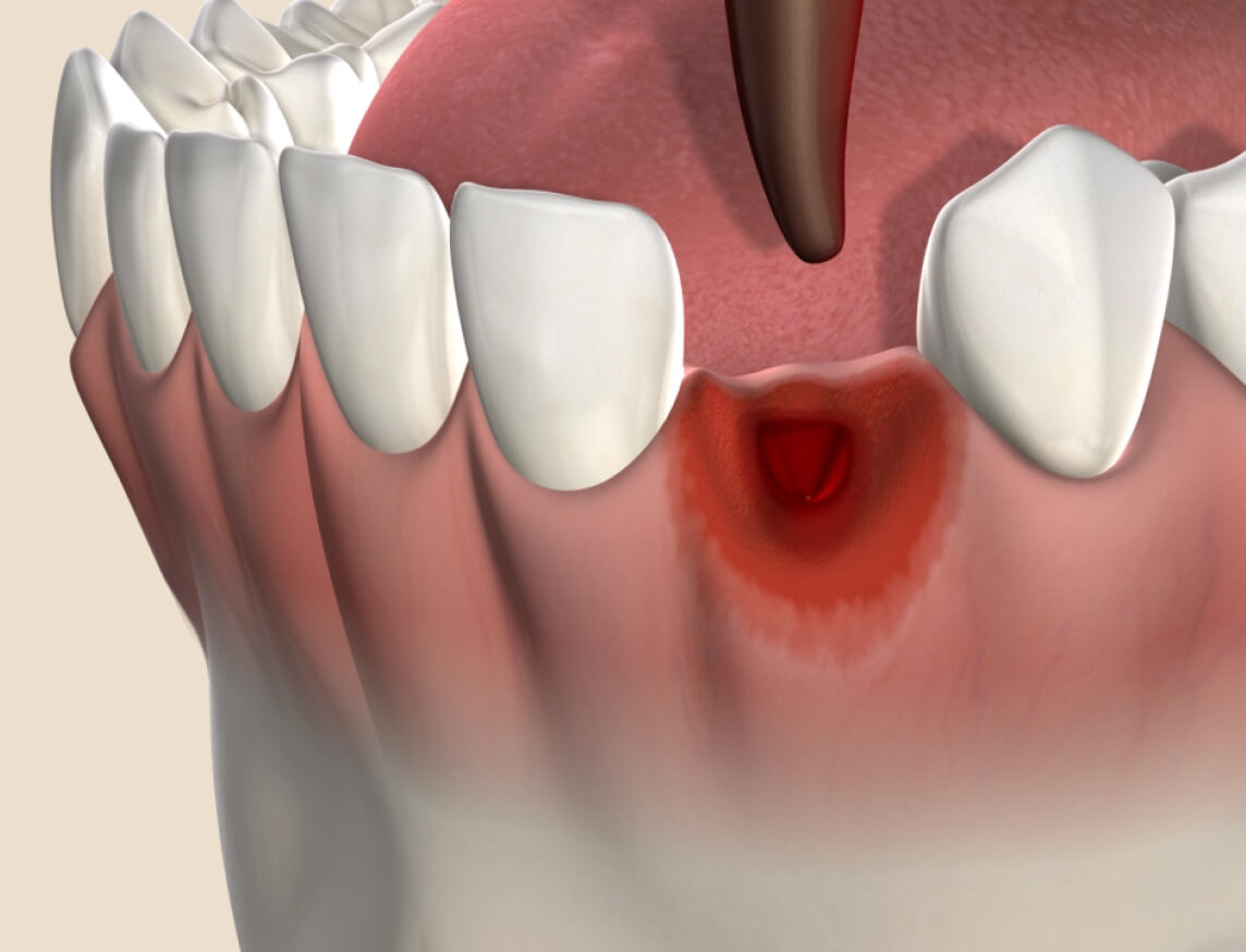 3D illustration of tooth extraction socket and oral surgery site after damaged tooth removal.