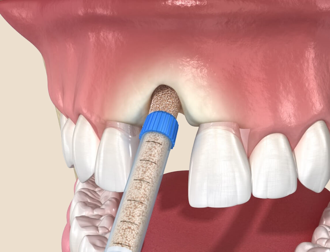 3D illustration of dental bone grafting for jawbone restoration before implant placement.