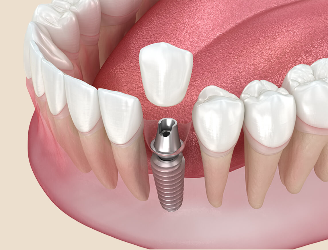 3D illustration of dental implant crown placement for single missing tooth replacement.