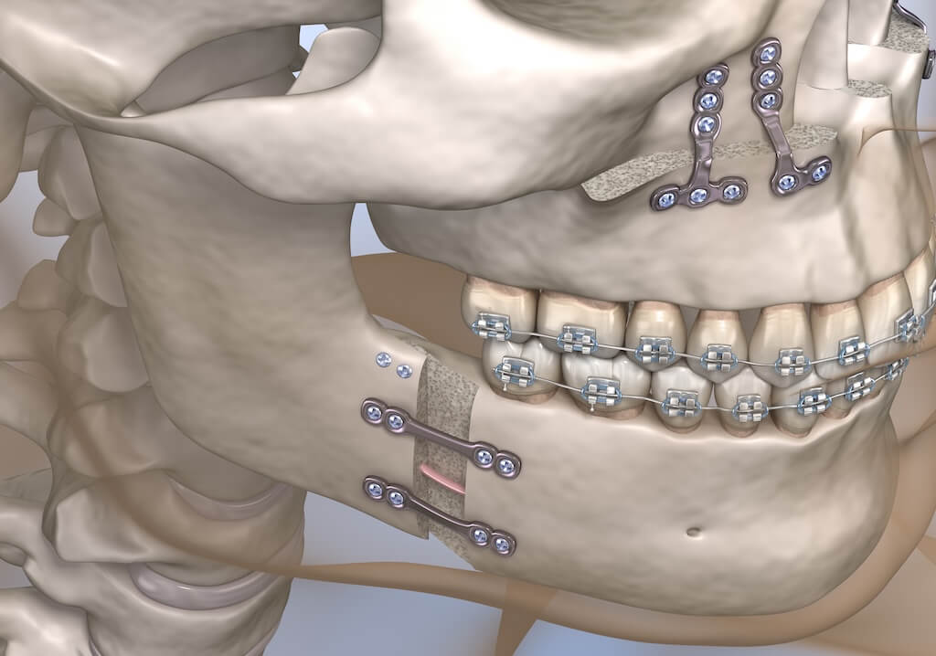3D illustration of orthognathic jaw surgery with braces, fixation plates, and bone grafting.