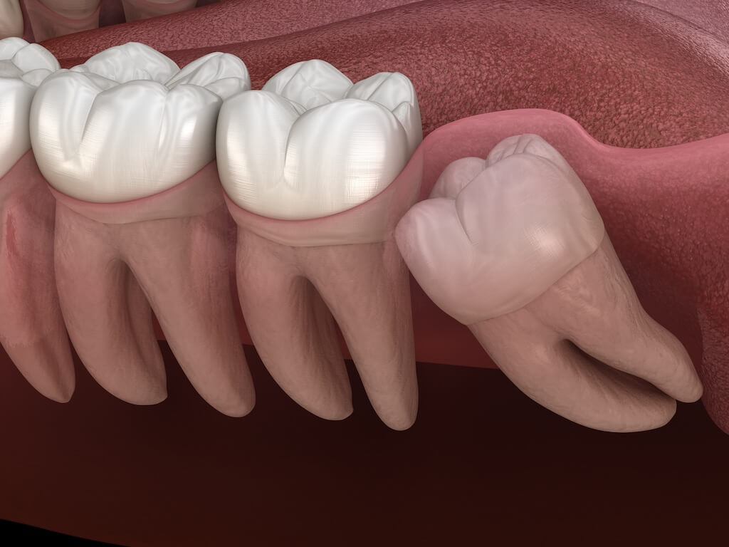 3D illustration of impacted wisdom tooth beside molars for oral surgery evaluation.